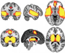 Mild-TBI, MR positive concussion